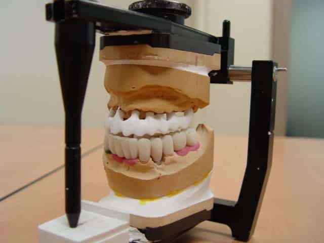 Cosmetic Dental Implant Restoration