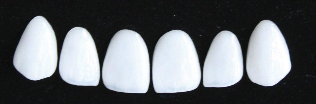 Cosmetic Feldspathic Veneers