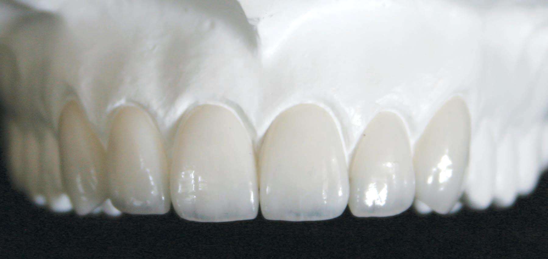 Cosmetic Porcelain Veneers Dental Lab