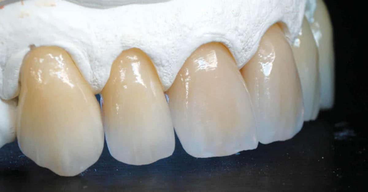 Zirconia Crown