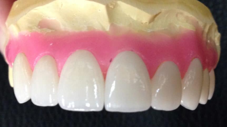 Cosmetic Porcelain Veneers iTero Dental Lab