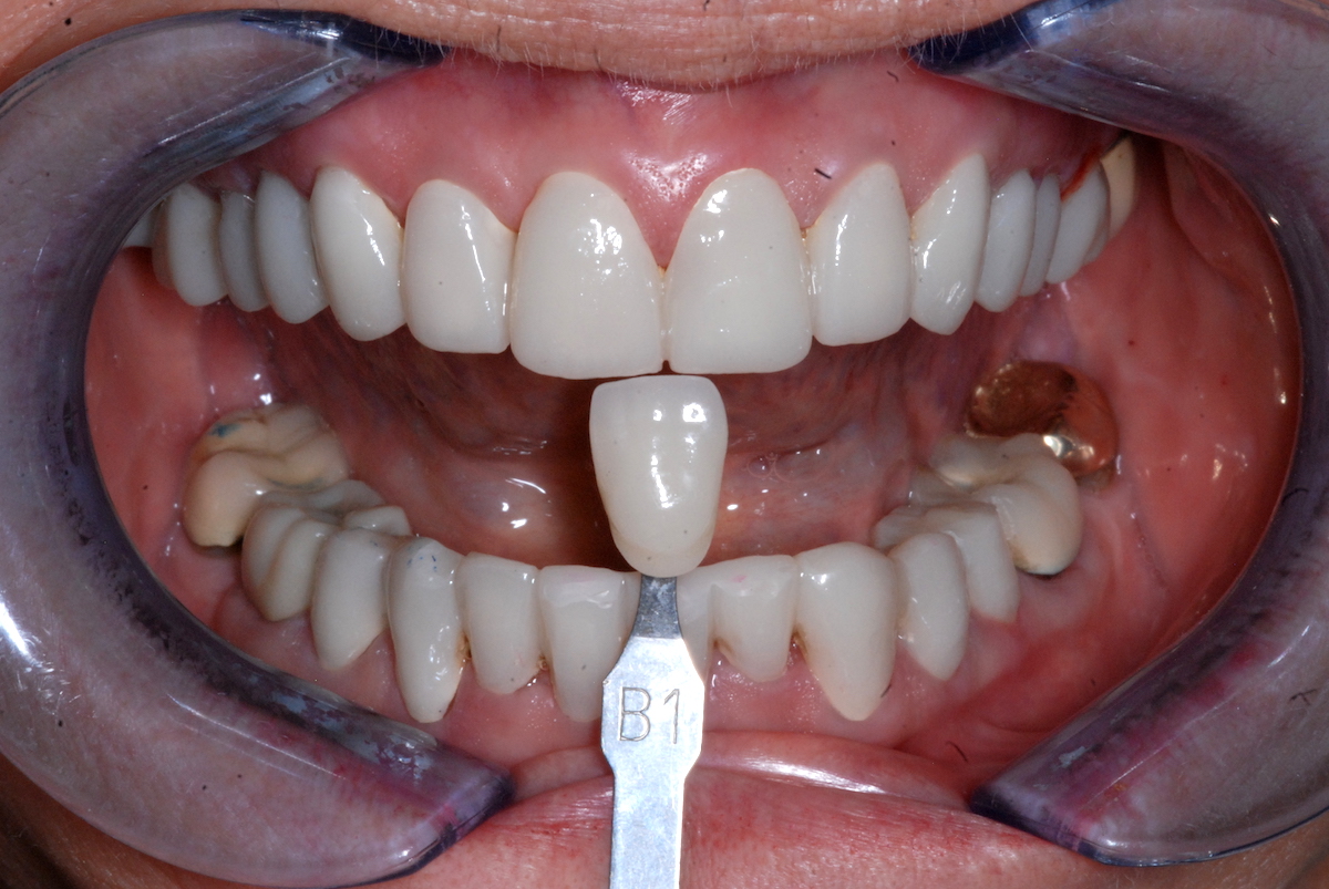 Dental Laboratory Custom Shade Matching