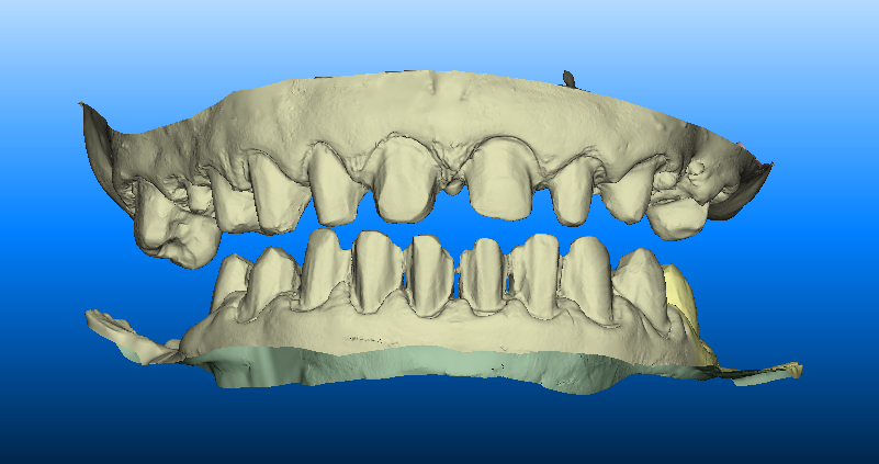 Featured image for “Digital Intraoral Scanner”