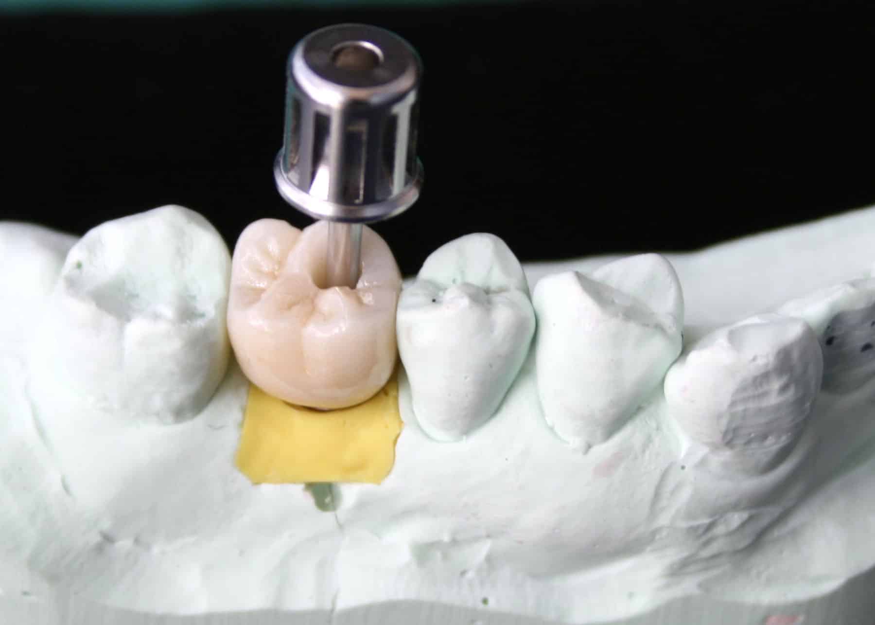 Screw-retained implant