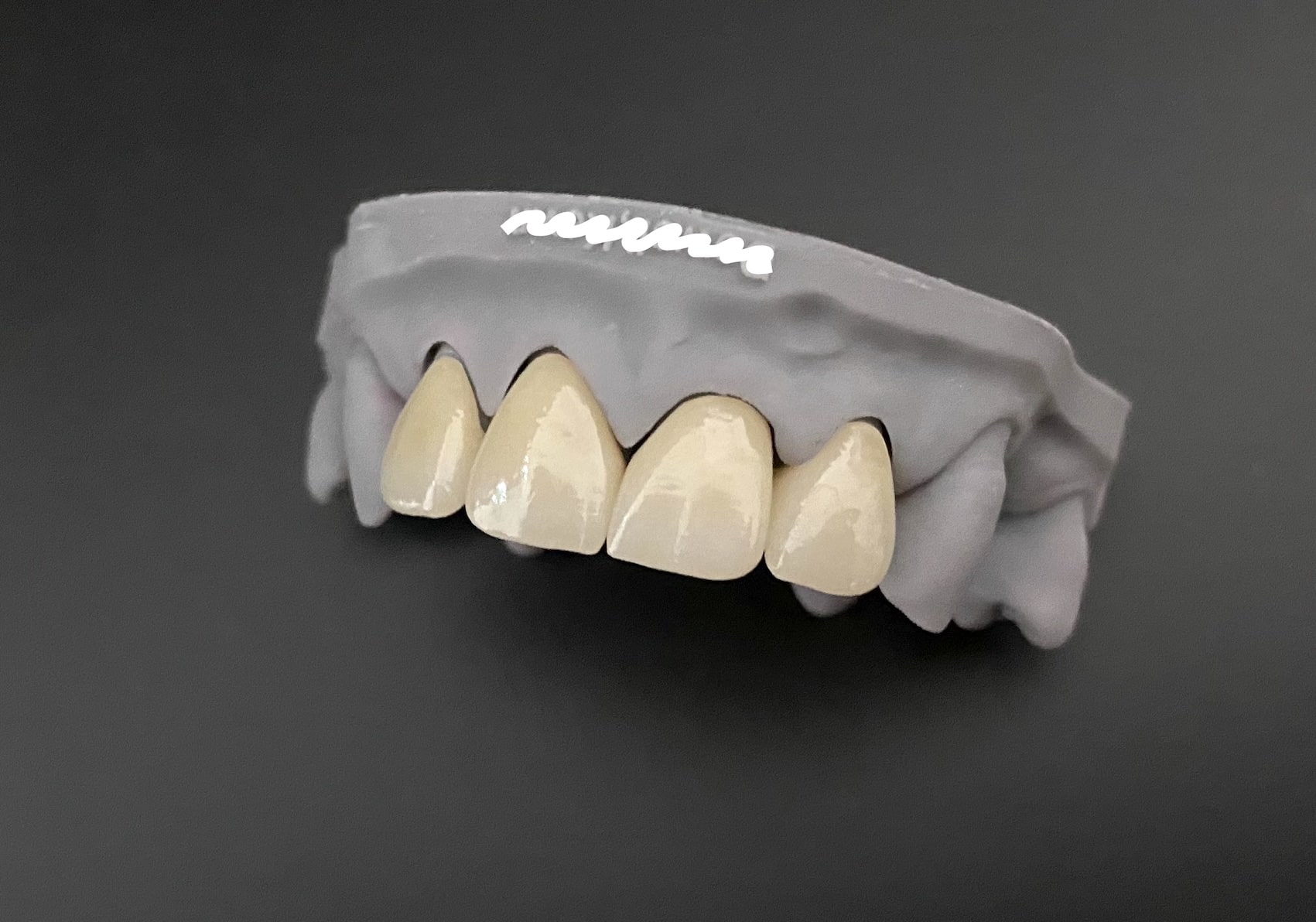 Featured image for “How to Bond Zirconia Crowns”