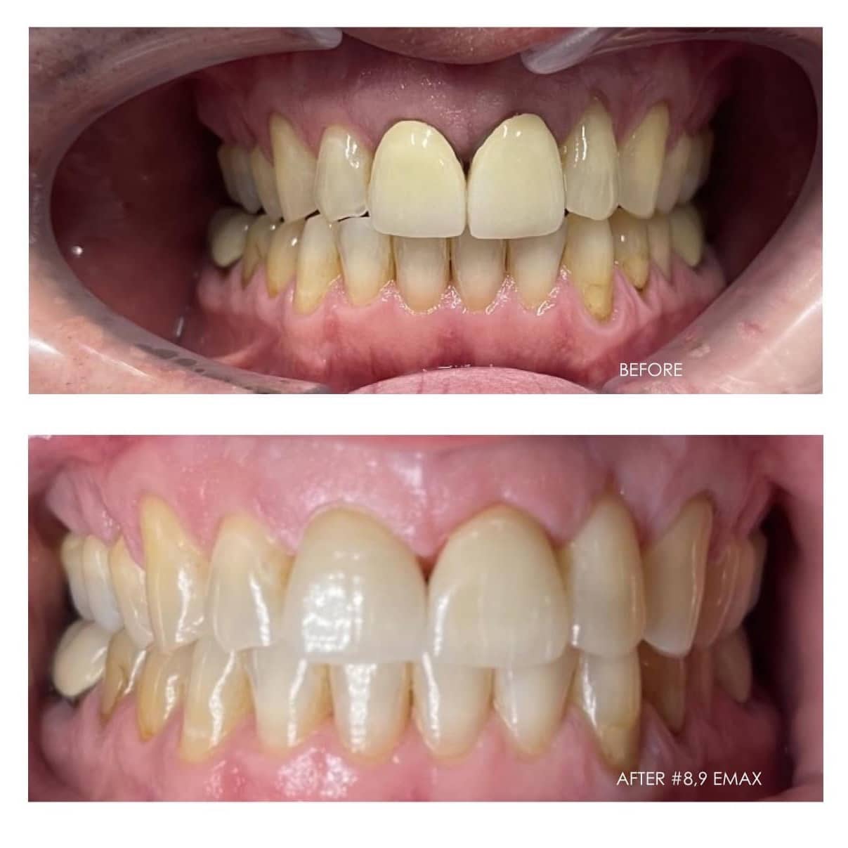 emax anterior crowns 89